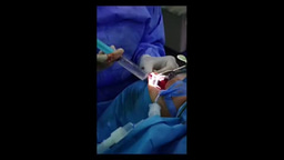 Bofares sign for the clinical diagnosis of choanal atresia