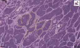 Tumour evolution: a tale of dispersal and interaction