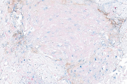 Transcriptome analysis reveals key information about a rare pediatric cancer and response to immune checkpoint inhibitor monotherapy