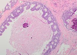 Pathological features of 11337 patients with primary ductal carcinoma in situ (DCIS) and subsequent events – results from the UK Sloane project