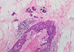 The presentation, management and outcome of patients with ductal carcinoma in situ (DCIS) with microinvasion (invasion ≤1 mm in size)—results from the UK Sloane Project