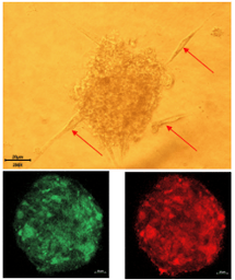 Unveiling human cytomegalovirus as a causal factor for glioblastoma. 