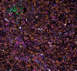 Understanding the immune responses in angiosarcomas and their clinical implications