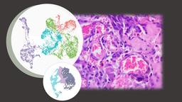 Unraveling the spatial immune landscapes of Asian head and neck angiosarcoma