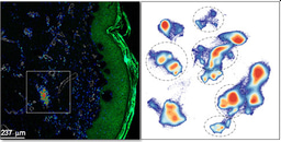 Unveiling the Immune System’s Role in Recessive Dystrophic Epidermolysis Bullosa: A Step Towards Targeted Therapies