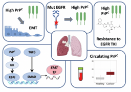 PrPC controls epithelial-to-mesenchymal transition in EGFR-mutated NSCLC: implications for TKI resistance and patient follow-up