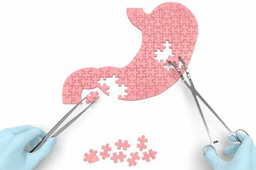 Malabsorption syndrome: causes, symptoms, diagnosis and management