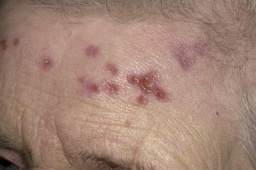 Could you identify this patient's unusual forehead marks?