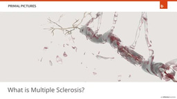Multiple Sclerosis 
