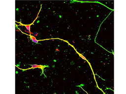 A new genome editing method by gene therapy could be a radical therapy for Charcot-Marie-Tooth disease type 1A due to duplication of 1.5 mega base genome region