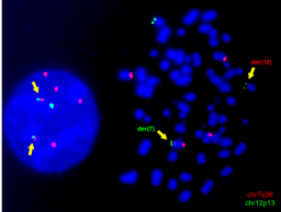 Engineering of chromosomal translocations to understand infant leukaemia