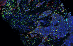Highly aneuploid lung cancers benefit from adding radiation to immune checkpoint blockade