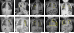PediCXR: Advancing the interpretation of common thoracic diseases in children