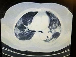 Call for papers: Connective tissue disease-associated interstitial lung disease