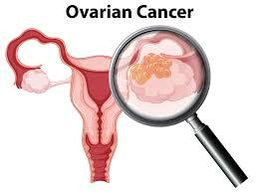 Unveiling the Evolving Fight Against Ovarian Cancer