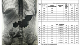 Managing Fluid Balance and Nutritional Status in a Short Bowel Syndrome Patient awaiting Intestinal Transplant: A Case Report.
