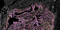 When Cancers Outsmart the Immune System from the Very Beginning