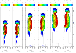 Why projection direction matters in pediatric full-spine radiography