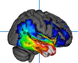 Before We Measure It, We Must First See It: Recognizing Right Temporal FTD