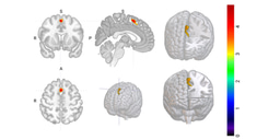 When Impulsivity Is Present but Hidden — A Neural Clue in Bipolar Vulnerability