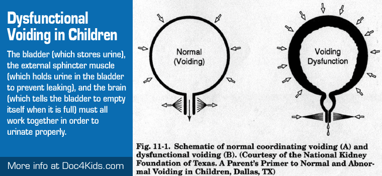 Voiding Dysfunction Visual in Children Image describing voiding dysfunction in children. A bladder on the right describes normal voiding and a bladder on the left describes voiding dysfunction