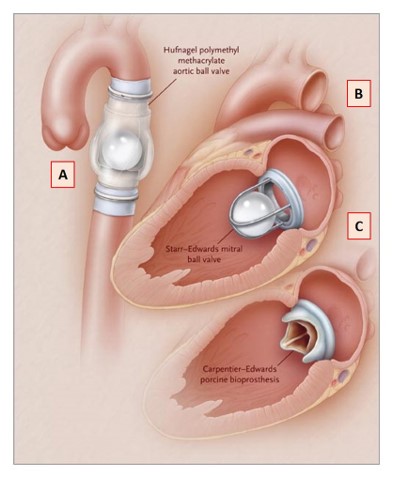 Pioneering heart valves engineered 