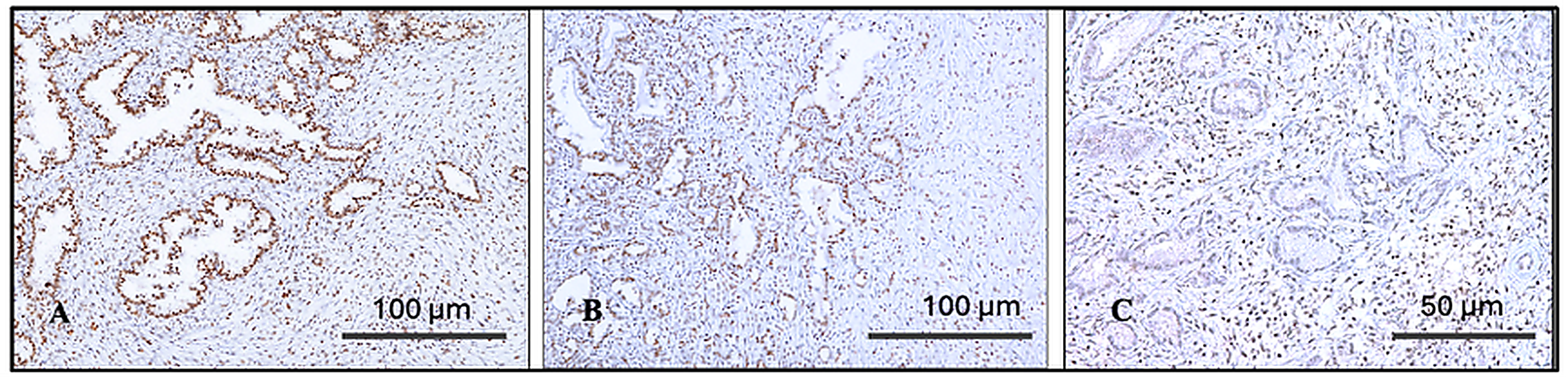 Representative FoxP3 immunohistochemical staining in pancreatic ductal adenocarcinoma demonstrating high (A), moderate (B), and low (C) lymphocyte infiltration within the tumor microenvironment.