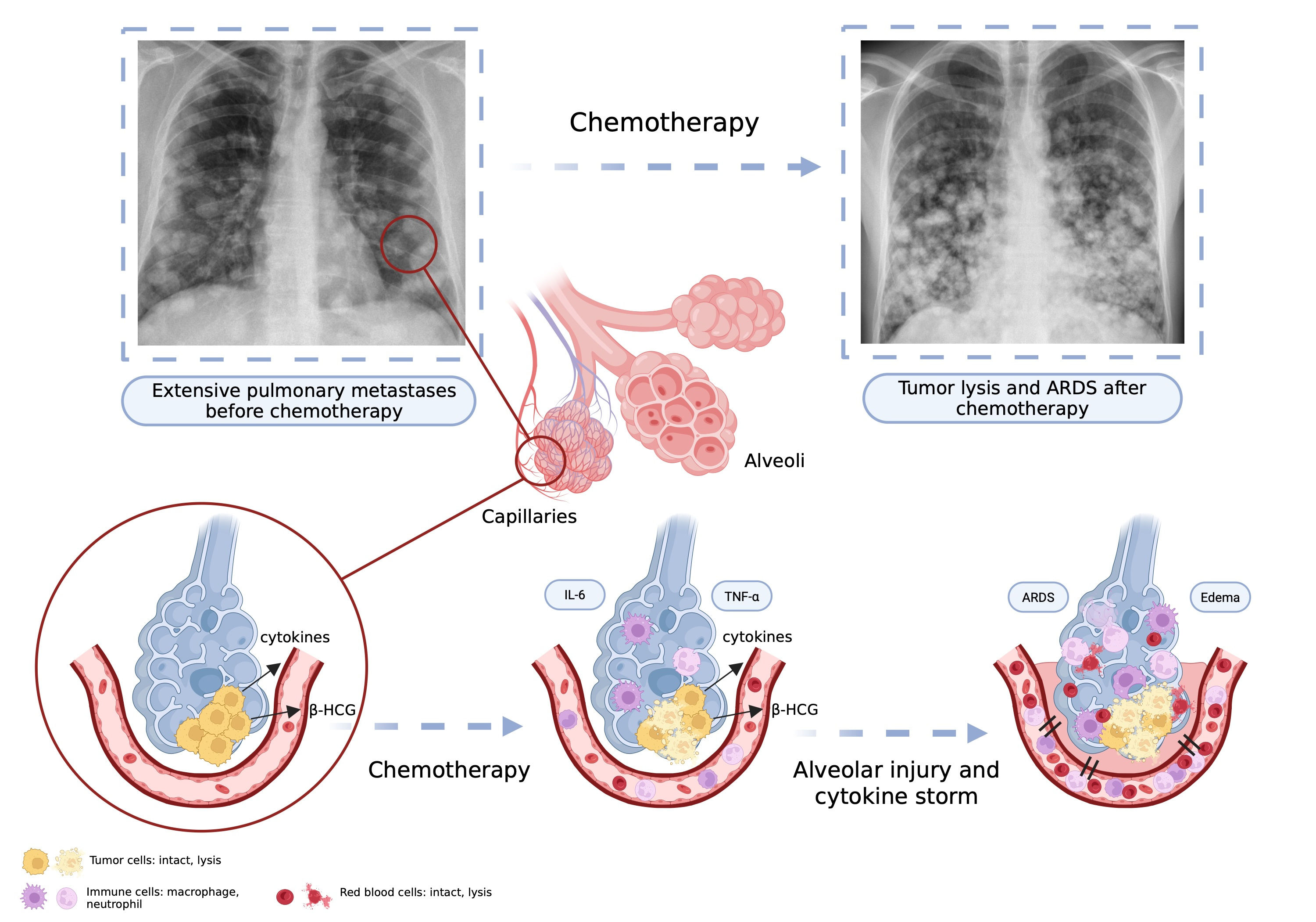 Patients with massive pulmonary involvement have limited respiratory reserve even before treatment initiation. Afterwards, rapid tumor destruction within lung metastases may induce release of inflammatory mediators and tumor-related factors, leading to cytokine production, immune-cell recruitment, alveolar–capillary barrier disruption, and diffuse alveolar damage. This may result in a self- amplifying inflammatory response resembling a cytokine storm, with progression to ARDS and early respiratory death. ARDS, acute respiratory distress syndrome