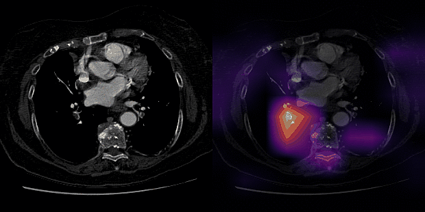 Axial contrast-enhanced CT pulmonary angiogram and Class Activation Map  inferred by PENet
