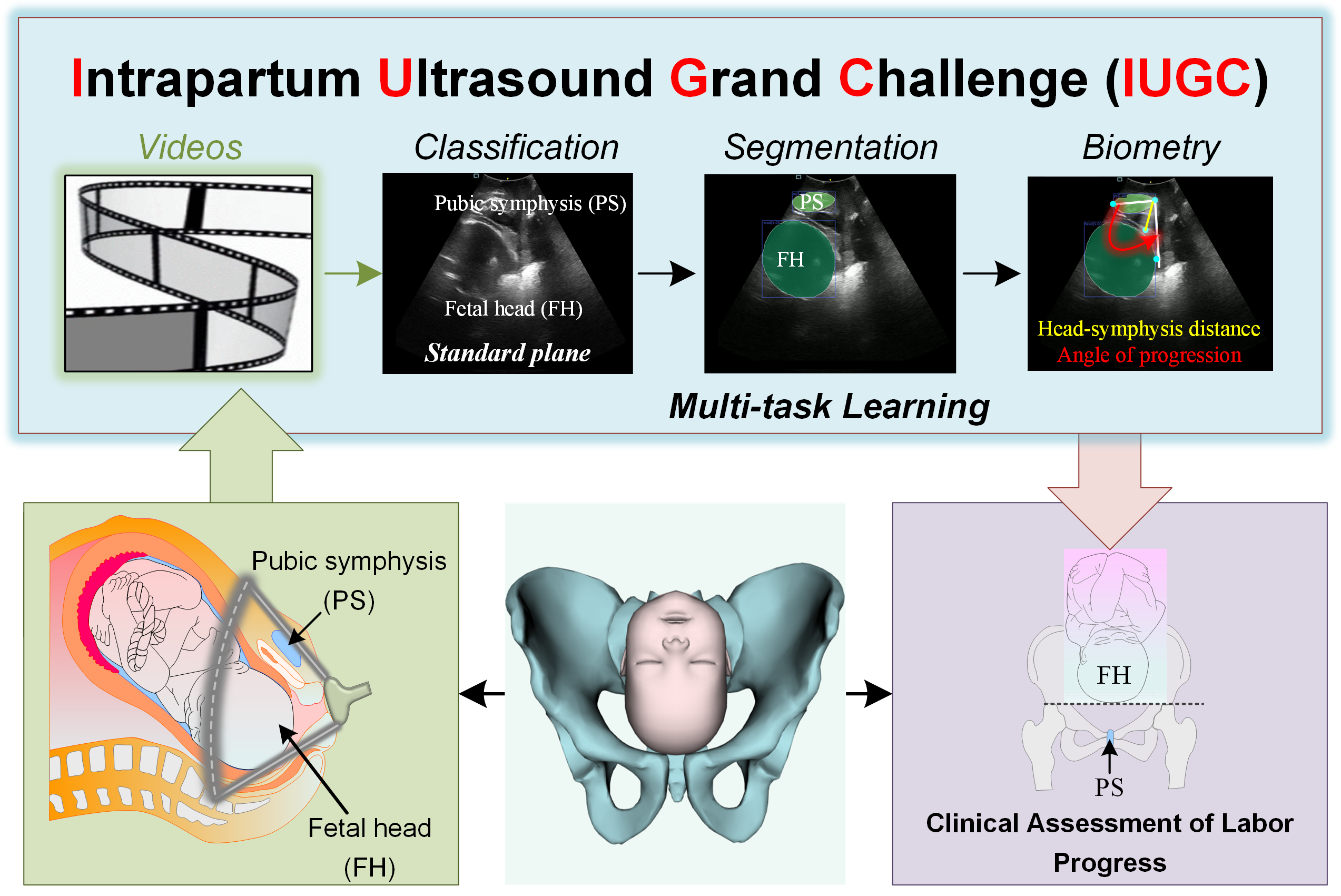 Overview of IUGC MICCAI Challenge