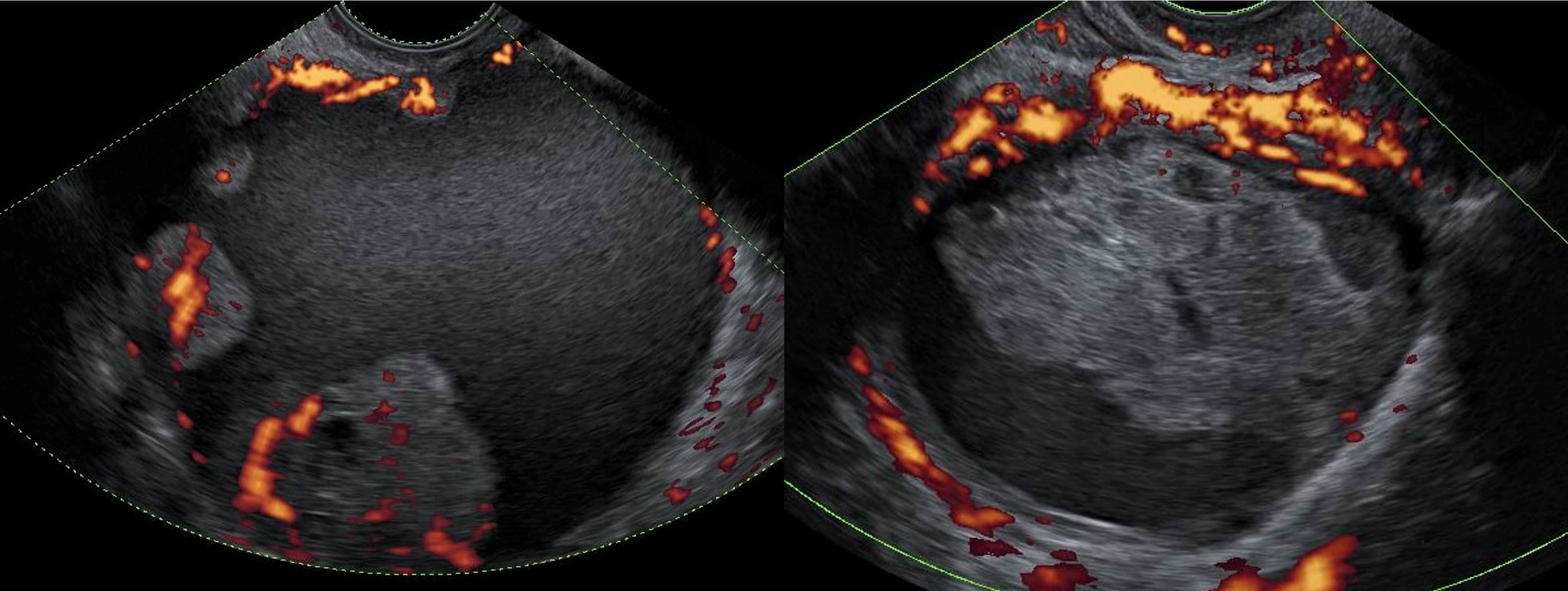 Two ultrasound images showing ovarian lesions with Doppler flow mapping, highlighting vascular activity in the tissues.