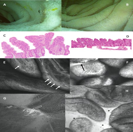 Evidence of enteropathy