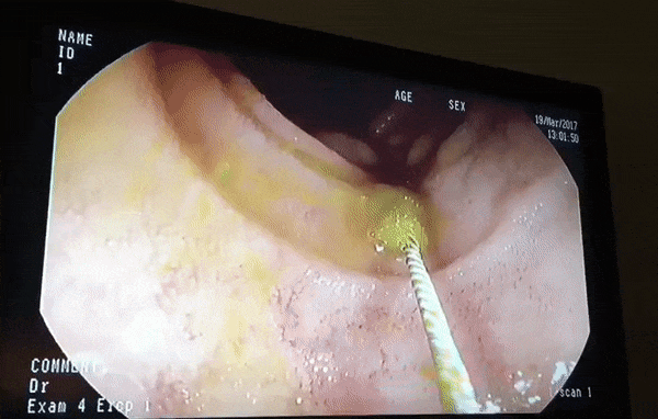 Sampling the colonic mucosa using a brush