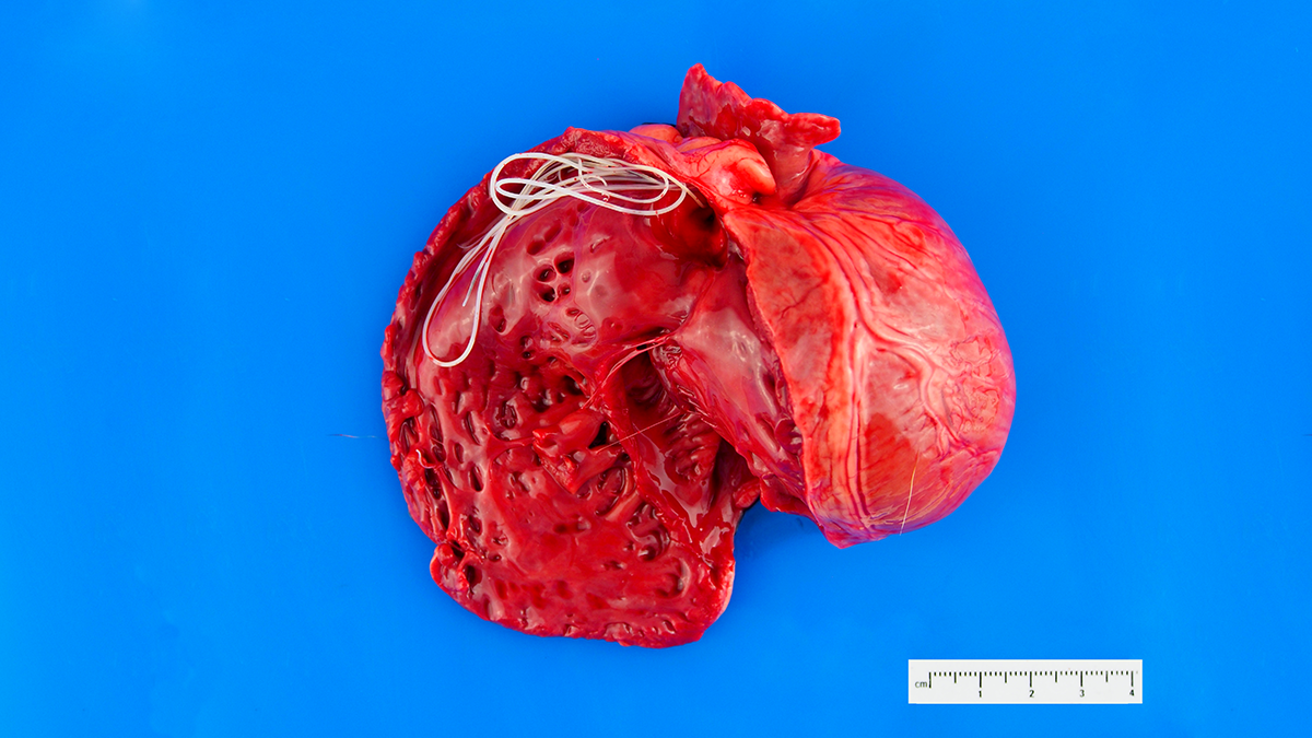 Dog's heart with heartworm (white "spaghetti")