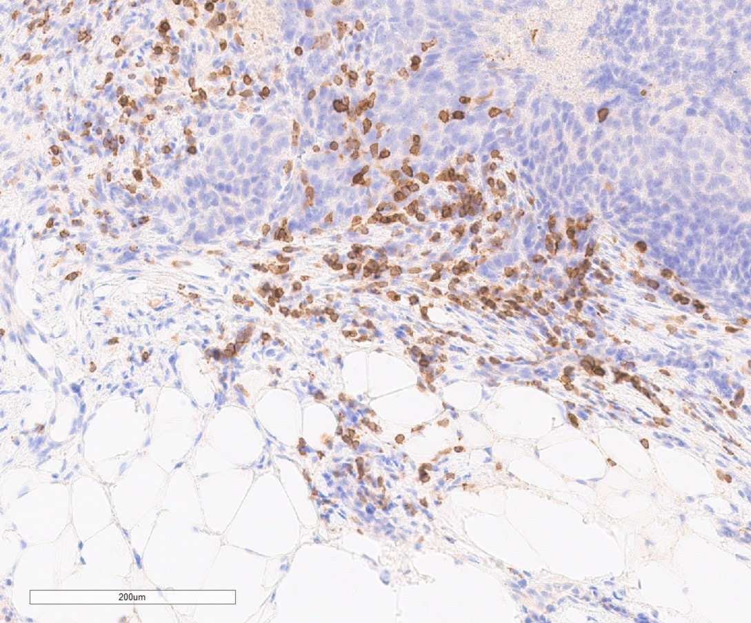 Histological section of ovarian cancer and adipose tissue