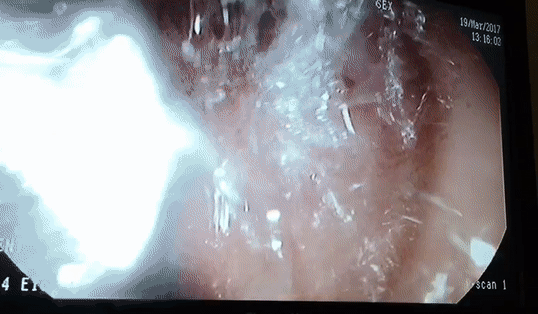 Sampling luminal aspirates from the gastrointestinal tract