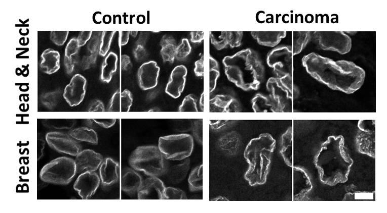 Examples of wrinkled nuclei from head and neck and breast tissue, both control and carcinoma. 