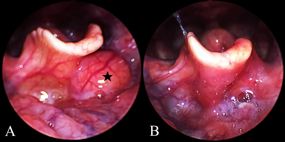 Pre- and post-operative images A 69-year-old female underwent videolaryngoscope-assisted coblation of epiglottic cysts. a Preoperative 70° rigid laryngeal endoscopic view showing an epiglottic cyst, depicted by a black triangle. b Postoperative 70° rigid laryngeal endoscopic view showing free of epiglottic cysts one month after surgery.