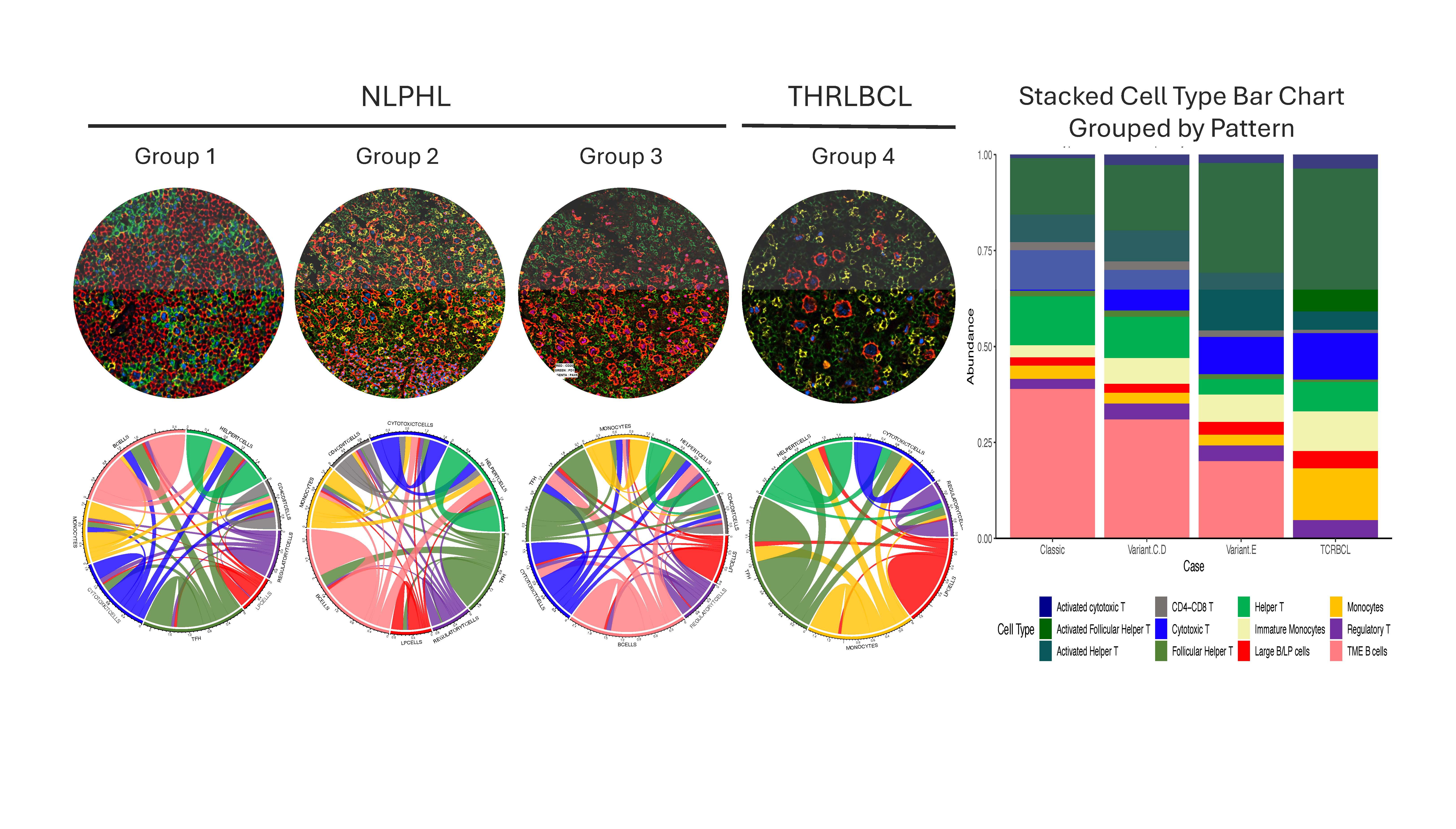 CODEX images show distinct organization of tumor B-cells and cellular composition of the tumor microenvironment in NLPHL groups and THRLBCL (left, top row). Circos plots show spatial organization and interactions among cell types within groups (left, bottom row). Stacked bar plots show relative abundance of cell types within groups (right).