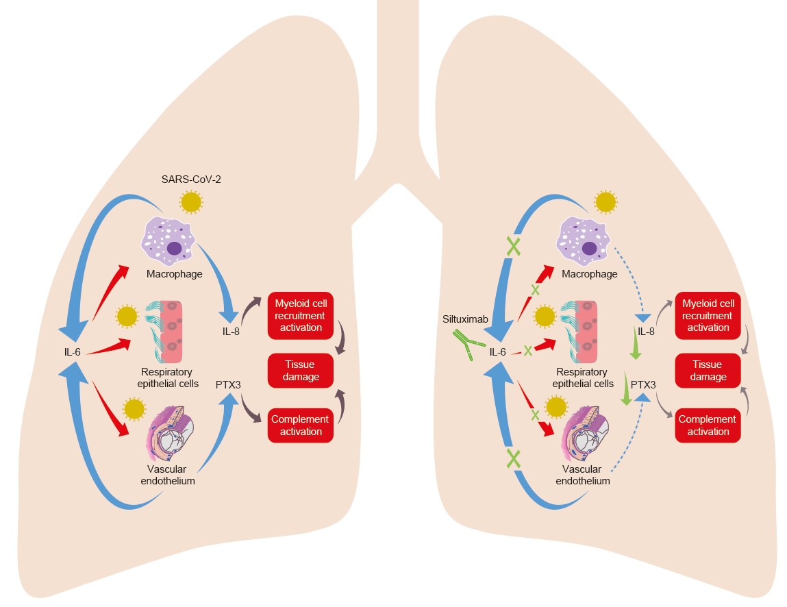 Schematic demonstrating siltuximab-mediated inhibition of local and systemic inflammation prognostic of improved respiratory function and survival.  