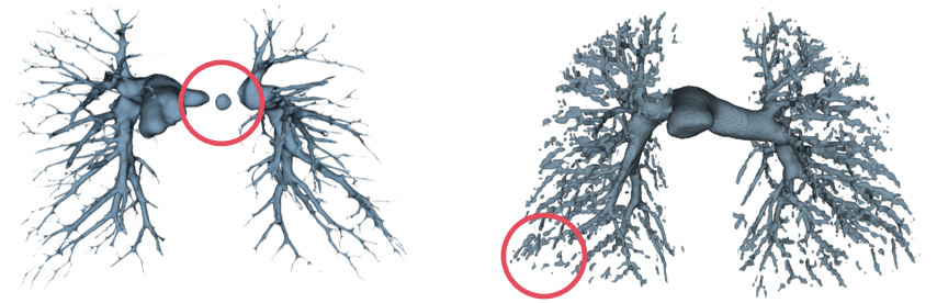 Results of artery and vein segmentation on a chest CT scan with substantial noise