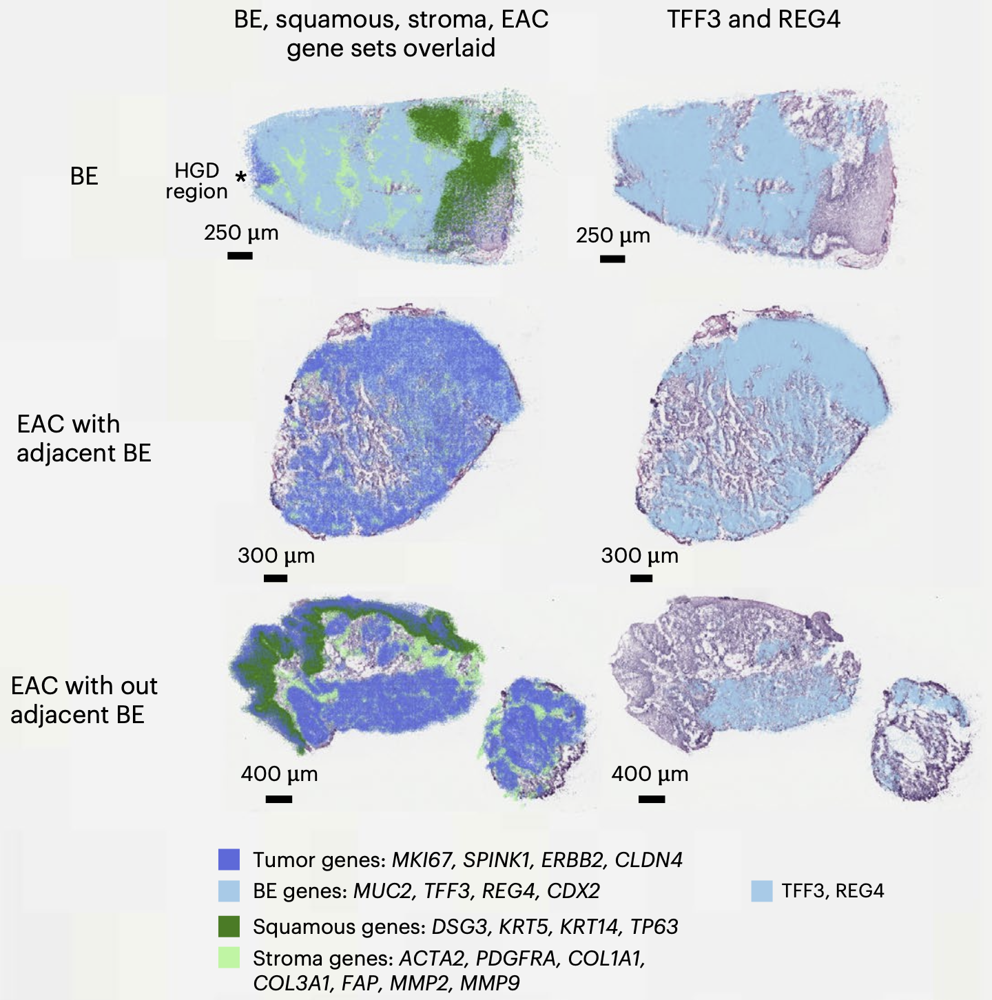 A six-panel spatial transcriptomics figure showing where different sets of genes are active within slices of oesophageal tissue — essentially a colour-coded gene activity map overlaid on the tissue itself. Three tissue types are shown (one per row):         Barrett's esophagus (BE, a pre-cancerous lining), oesophageal cancer with neighbouring Barrett's tissue, and oesophageal cancer without any Barrett's tissue nearby.                                                                                                                                                                                                                                                                                                                                                                    ▎ In the left column, four tissue compartments are colour-coded: cancer cells (dark blue), Barrett's-type gland cells (light blue), squamous (normal gullet lining) cells (dark green), and structural support/stroma cells (light green). In the right column,     only two key Barrett's marker genes — TFF3 and REG4 — are shown in light blue.                                                                                                                                                                                                                                                                                                                                                                                                                                                          ▎ The key story: Barrett's tissue lights up strongly for TFF3/REG4 (its defining markers). In cancers that arose alongside Barrett's tissue, TFF3/REG4 signal is seen around the edges but is largely absent from the tumour core. In cancers that arose without    Barrett's tissue, TFF3/REG4 signal is almost entirely gone, and the tumour shows more mixed cell types including squamous and stromal cells — suggesting these Barrett's-negative cancers have a fundamentally different cellular composition and may arisethrough a distinct biological route. 