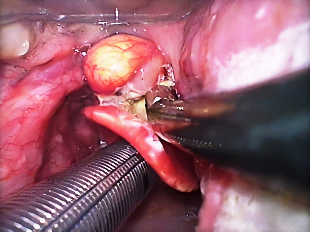 Intraoperative photograph