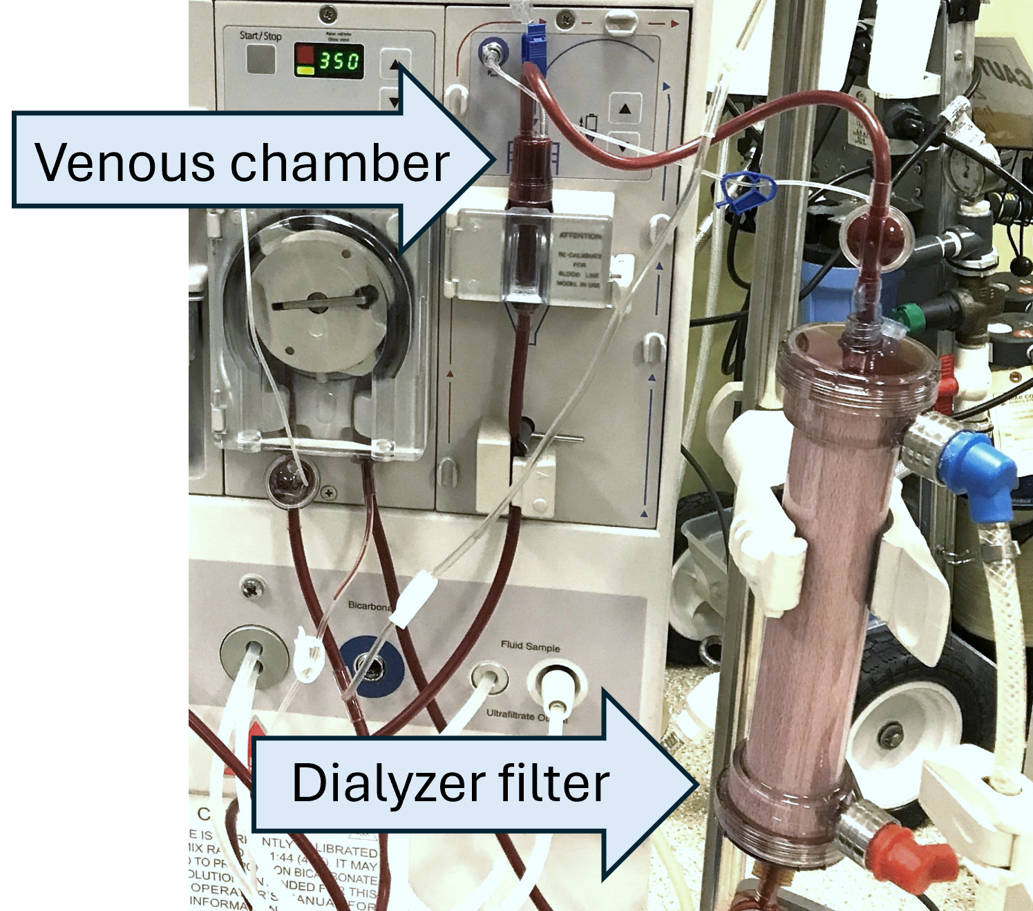 A visual scoring scale was used determine whether AB002 reduced clotting severity within the dialyzer circuit. This photograph of an intact dialyzer circuit shows the tubing, venous chamber and dialyzer filter that comprise the circuit.  At the end of each hemodialysis session, the circuit was inspected by a trained medical aide and assigned a numerical score to categorize the degree of clotting  within the venous chamber, shown here on the left and the filter, shown here on the right. After the circuit was scored, the filter was processed to quantify blood entrapment within the filter itself. 