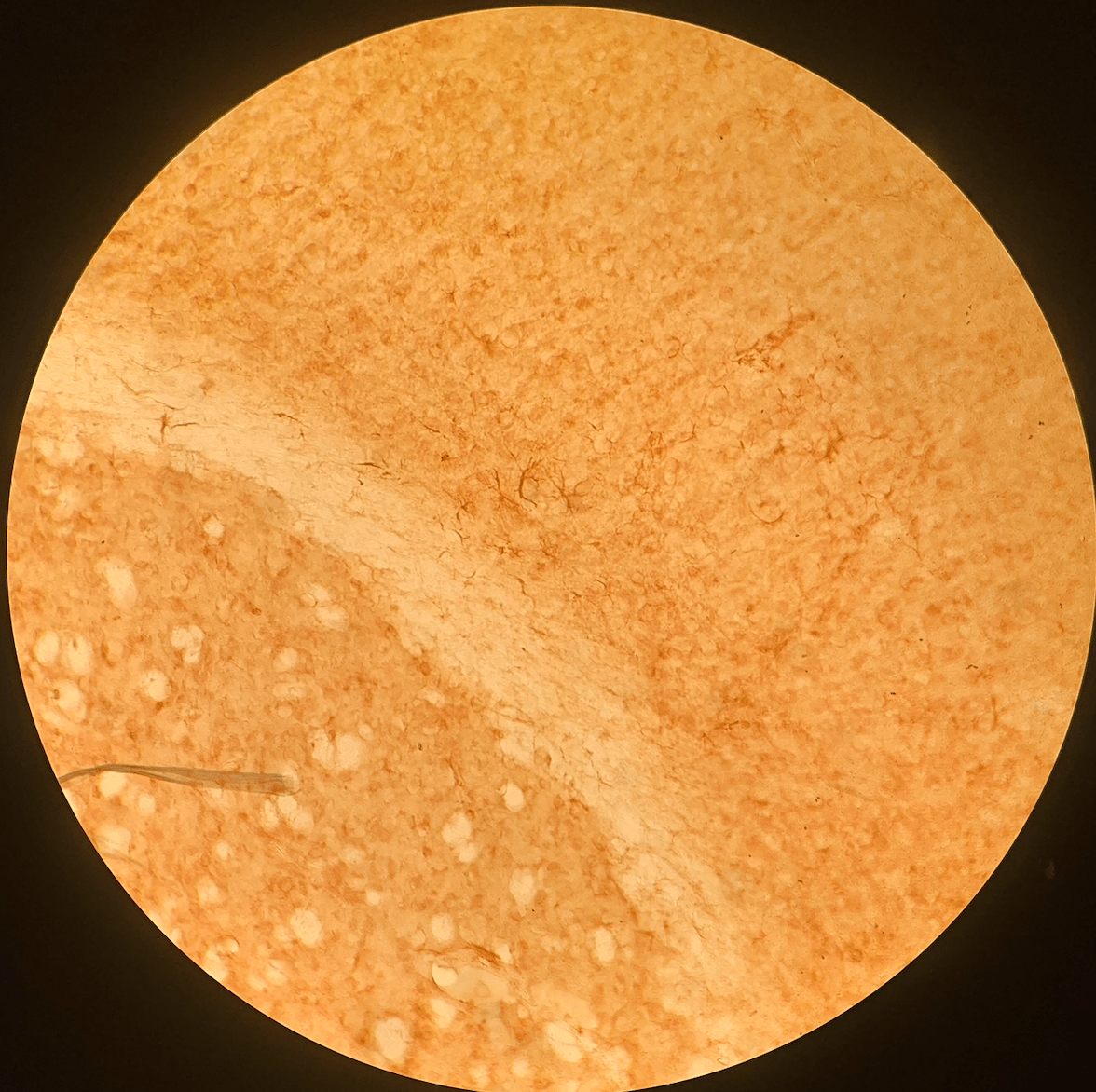 Senescent astrocytes stained using Beta-Galactosidase Immunohistochemistry