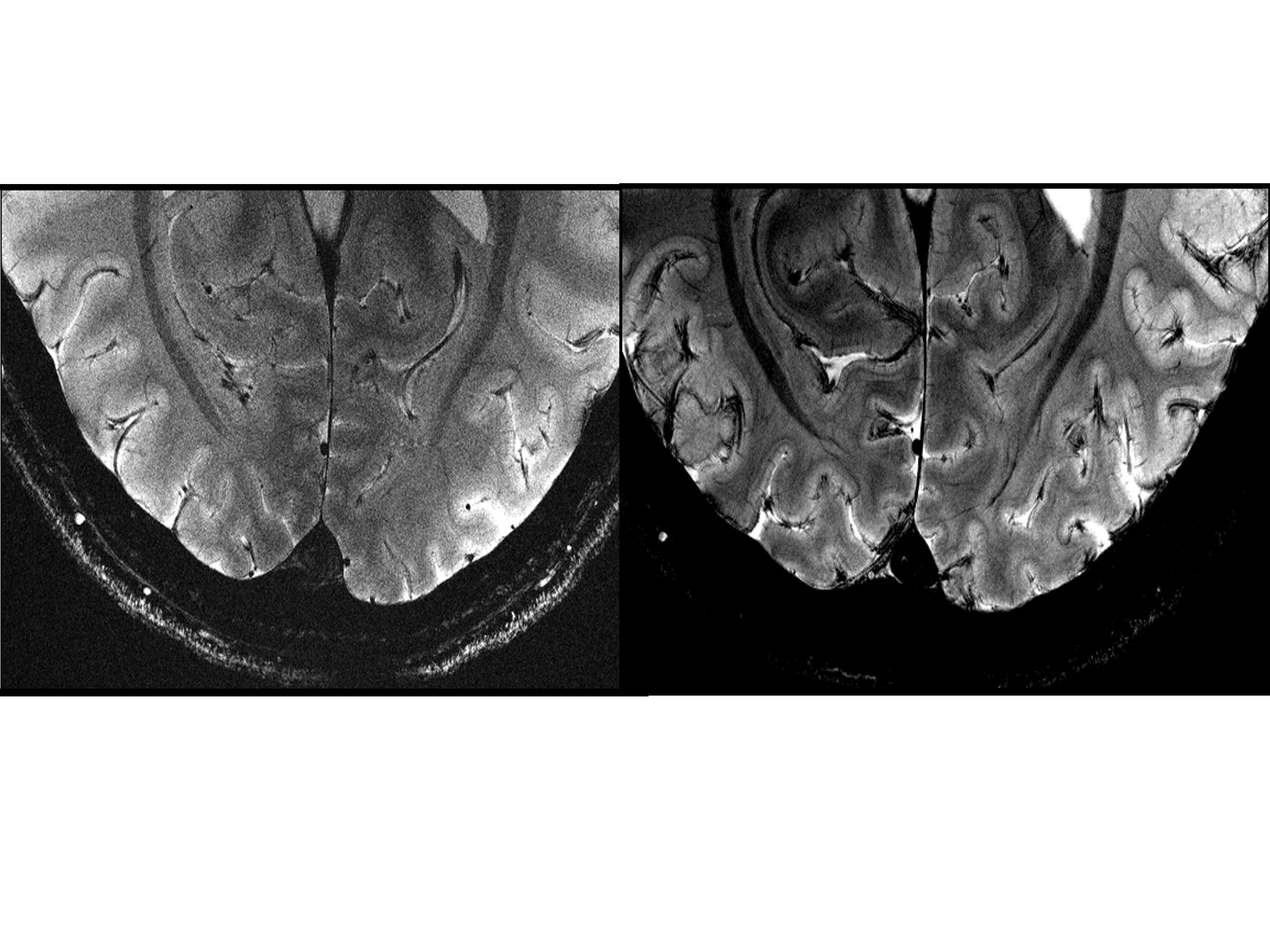 Acquisitions were performed with resolution = 0.2 × 0.2 × 1 mm3, FA=27°, TE=20 ms, TR=0.6 s, bandwidth = 40 Hz/pixel, acquisition time = 4 min 20 s. Details within the cortical ribbon become clearly visible at 11.7T and not at 7T due to poorer signal and contrast to noise ratios.