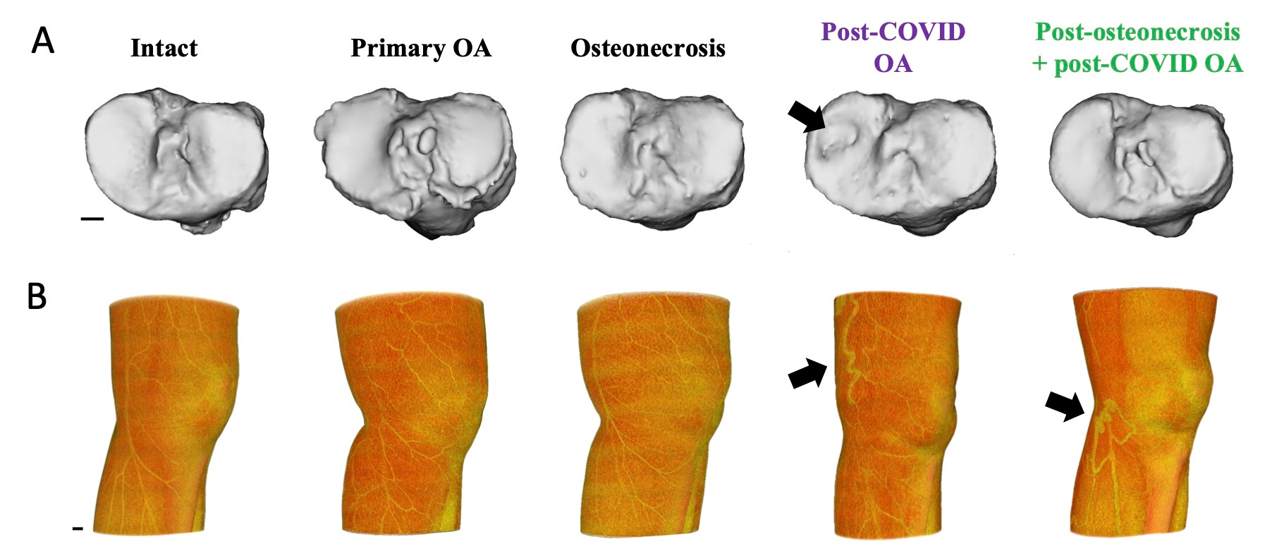 A, 3D reconstruction of tibial plateau of knee joints; the arrow indicates the collapse of the medial tibial plateau. OA, osteoarthritis. B, 3D volume-rendered CT images showing the vessel distribution at the skin level; arrows indicate bulging or twisted vessels. Scale bars, 1 cm.