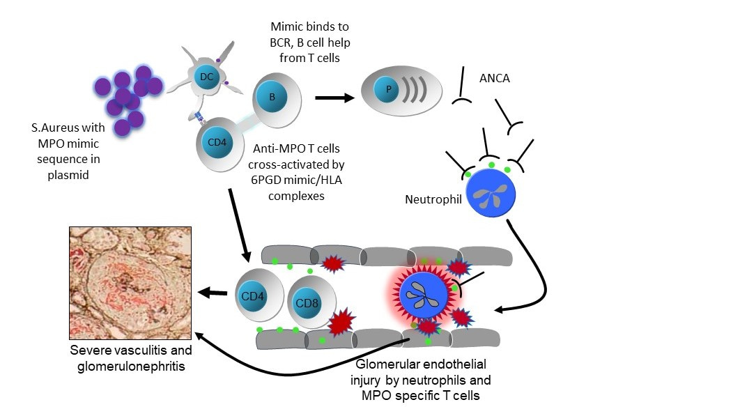 Plasmid-derived S.aureus 6PGD in ANCA-associated vasculitis