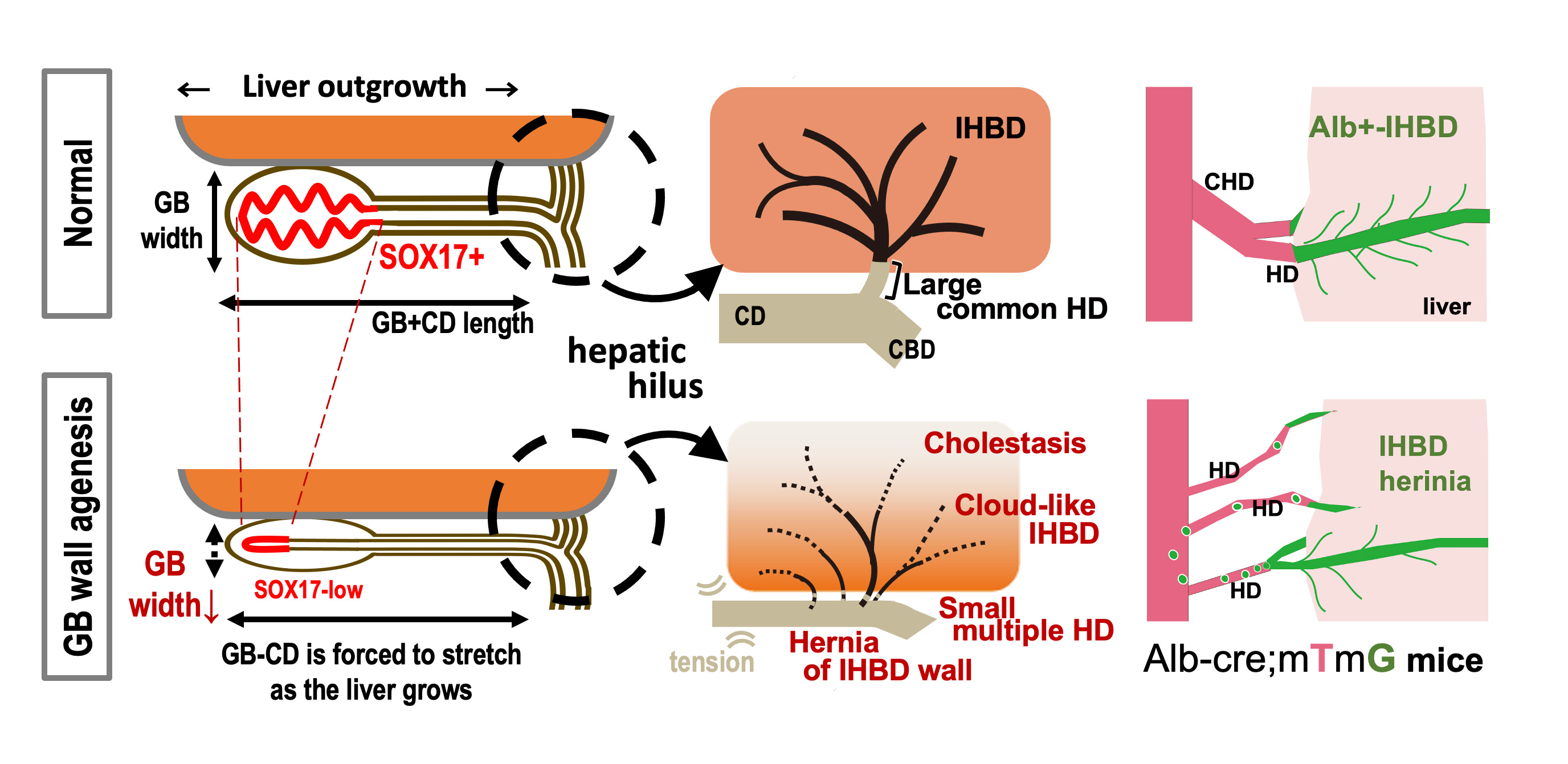 Small gallbladder due to low SOX17 expression affects bile ducts int the hepatic hilum and cause aberrations in the bile ducts inside the liver.