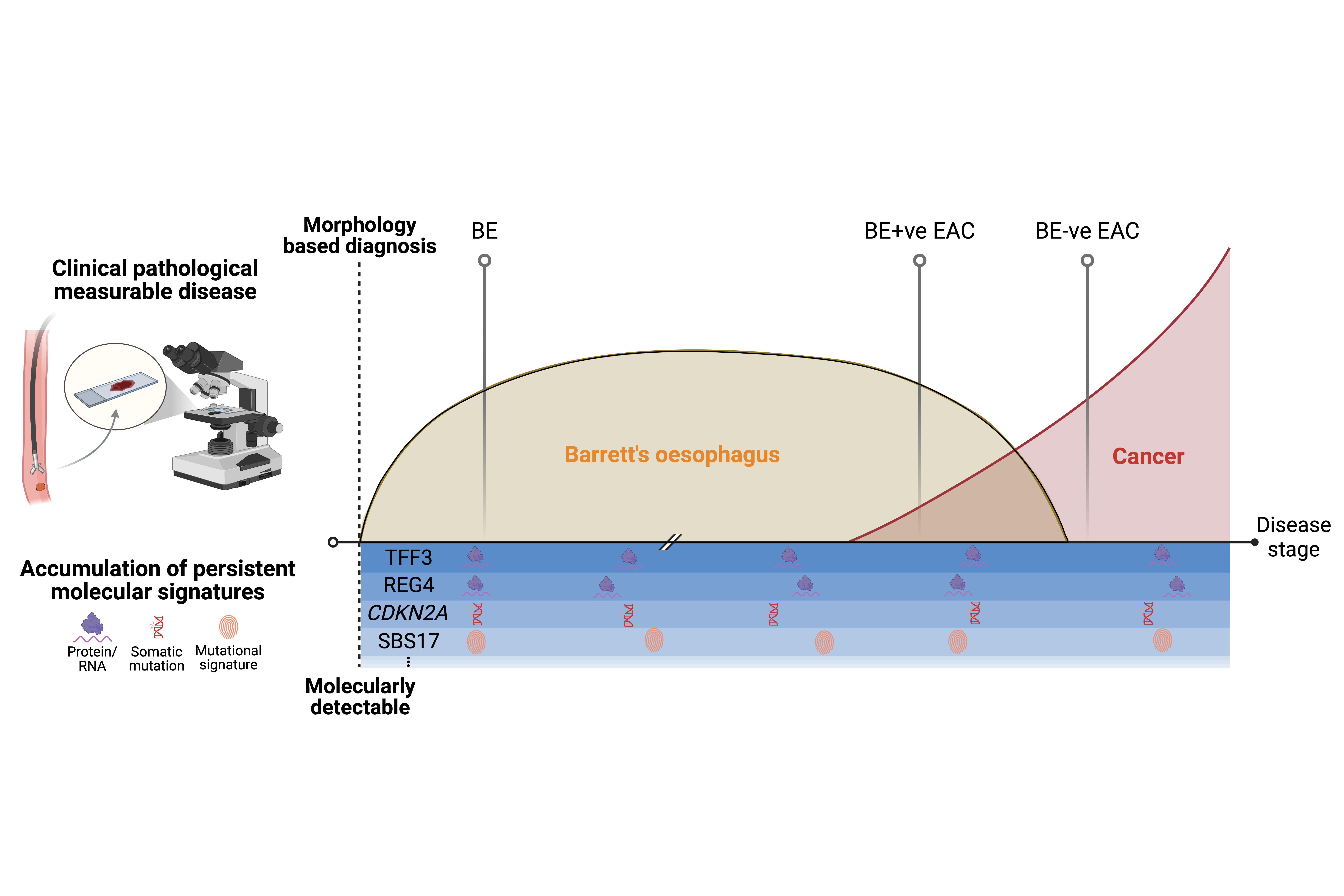 A conceptual diagram showing how oesophageal cancer may develop along a disease progression timeline, even in patients who show no visible sign of Barrett's oesophagus at diagnosis. The horizontal axis represents disease stage, moving from early changes on the left through to advanced cancer on the right. A large tan curve represents the rise and fall of detectable Barrett's tissue — it peaks in the middle and then declines. A red      curve rises on the right, representing cancer. Two cancer types are marked: BE-positive EAC (cancer with detectable Barrett's tissue nearby) and BE-negative EAC (cancer without it).                                                                                                                                                                                                                                                                                                                                                   ▎ Two important thresholds are marked: a dashed vertical line where Barrett's tissue becomes visible under a microscope (morphology-based diagnosis), and an earlier threshold where molecular changes can first be detected in cells — before anything looks       abnormal under a microscope.                                                                                                                                                                                                                                                                                                                                                                                                                                                                                                            ▎ Four molecular markers — TFF3, REG4 (gene activity markers of Barrett's tissue), CDKN2A (a cancer-associated gene mutation), and SBS17 (a DNA damage fingerprint) — are shown as persistent bands running across the entire timeline, including into              BE-negative cancer.                                                                                                                                                                                                                                                                                                                                                                                                                                                                                                                     ▎ The key message: even when Barrett's tissue is no longer visible in a patient's gullet, the molecular footprints it left behind may still be detectable in the cancer cells. This supports the idea that Barrett's-negative oesophageal cancer may have           originated from Barrett's tissue that was later overgrown or disappeared — rather than being a completely separate type of cancer with a different origin. 